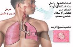 اليوم العالمي للسل